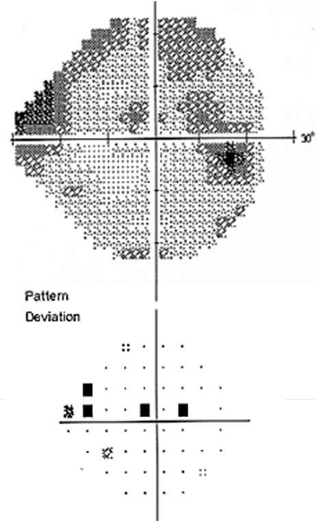 Image result for Visual Field Screen