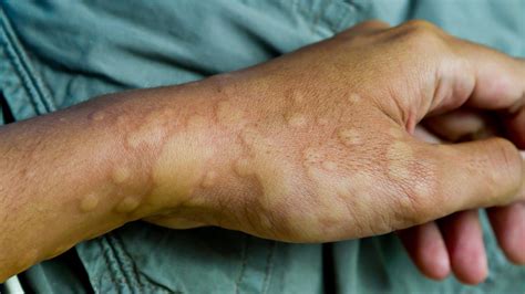 Psychodermatology: All About Stress-Induced Skin Reaction ...