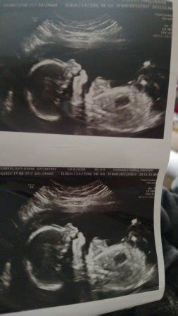 20 Week Ultrasound..Black holes? | BabyCenter