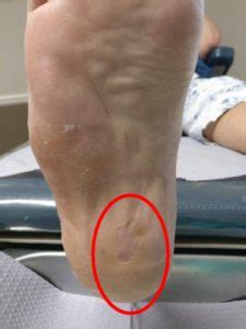 How to treat stone bruise? – HappyWalk - Orthopedic & Diabetic Footwear ...