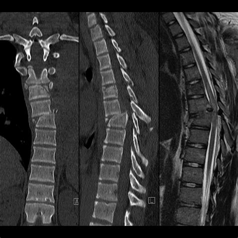 Pediatric Thoracic Spine Fracture | Pediatric Radiology Reference Article | Pediatric Imaging ...