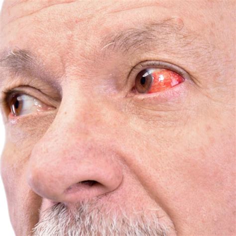 What are the causes of eye bloodshot? - Chadderton Opticians