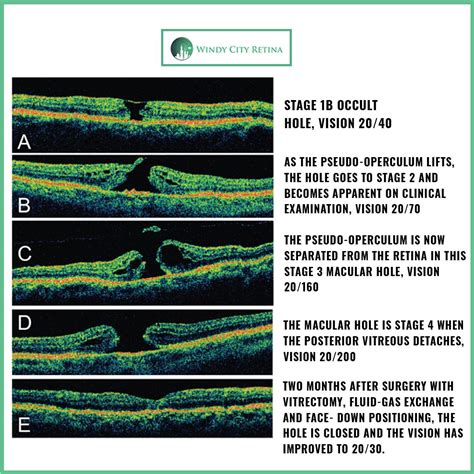 Understanding the Progression of Macular Hole with Optical Coherence Tomography