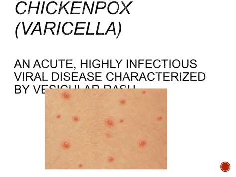 CHICKENPOX (VARICELLA).pptx