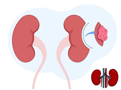 Image result for Simple Nephrectomy