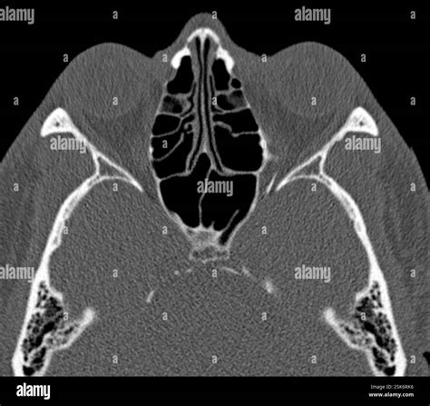 Normal Sinus Ct Scan