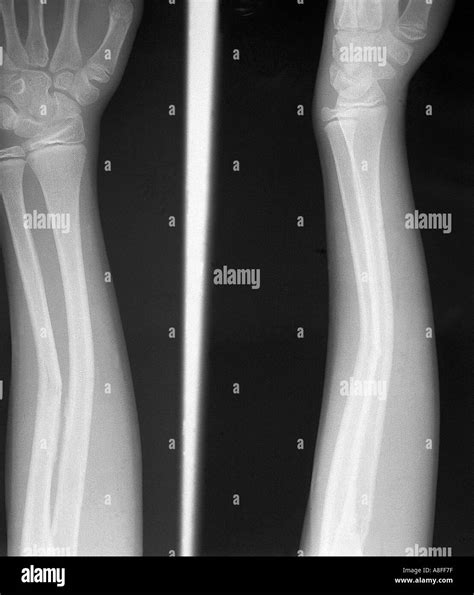 Radius Ulna Fracture X Ray at Nancy Green blog