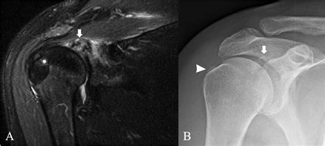Calcium hydroxyapatite deposition disease: Imaging features and ...