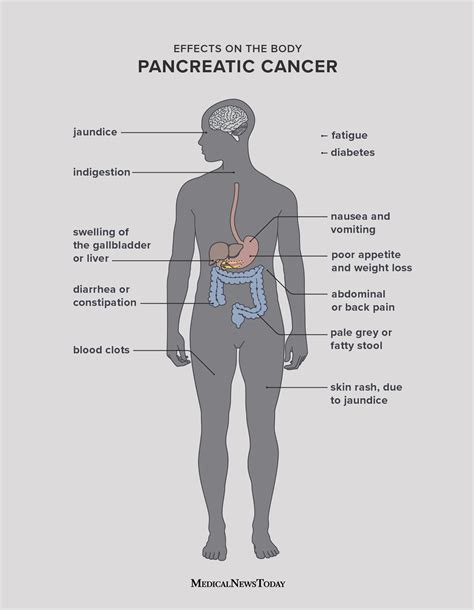 Pancreatic cancer: Symptoms, causes, and treatment
