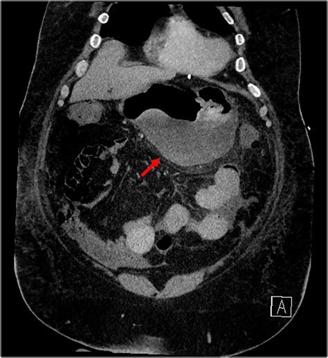 Endoscopic Sleeve Gastroplasty - Gastrointestinal Endoscopy Clinics