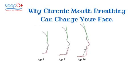 Mouth Breather Vs Nose Breather Face Shape at Frances Mayle blog