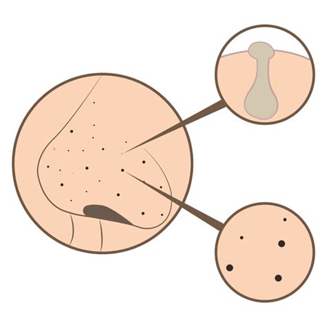 Nose Blackheads: Home Remedies To Remove Black Pores on Nose