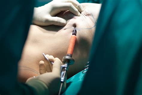 DIEP Flap Surgery: Breast Reconstruction Procedure and Recovery