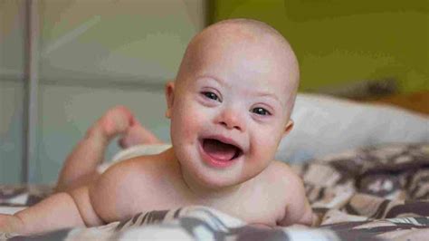 What is Down Syndrome: Causes, Symptoms & Treatments Guide