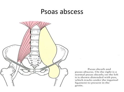 Image result for Psoas Sign