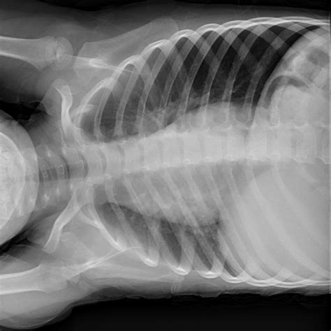 A Screwy Case of Pediatric Shortness of Breath — BROWN EMERGENCY MEDICINE