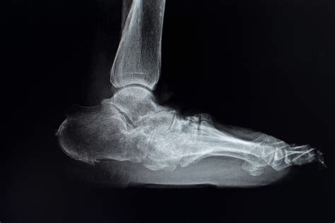 Charcot Arthropathy - Custom Orthotic