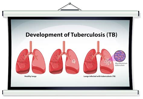 Vetores de Tuberculose - Baixe vetores grátis de alta qualidade do ...