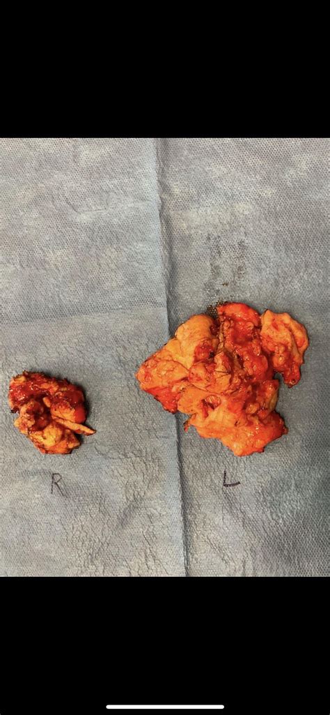 Update on Hematoma/Post Surgery : r/gynecomastia