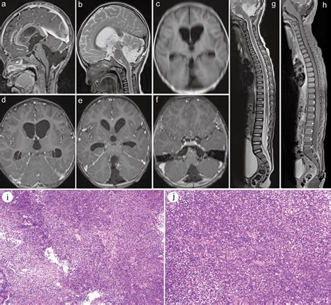 Pediatric Atypical Teratoid/Rhabdoid Tumor of the Cerebellum: A Case Report and Literature Review