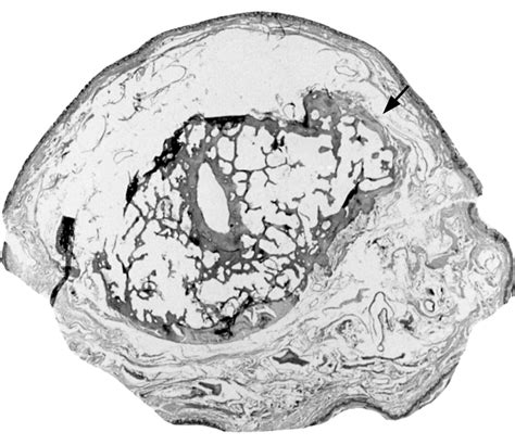 Heberden's and Bouchard's nodes - Annals of the Rheumatic Diseases