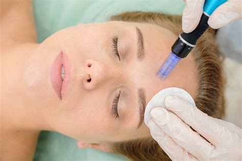Microneedling: A Revolutionary Hair Loss Treatment | IGBeauty Blog