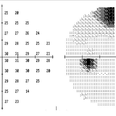 Image result for Peripheral Visual Field Defect
