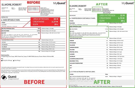 chronic kidney disease treatment: A Holistic Approach kidney health ...