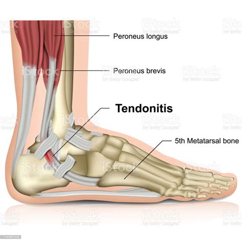 Peroneal Tendonitis Ankle Joint 3d Medical Vector Illustration Stock ...