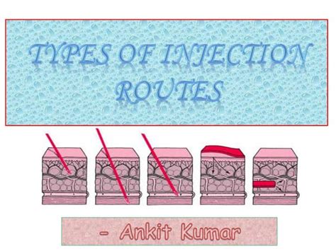 All Types of Injection 的图像结果