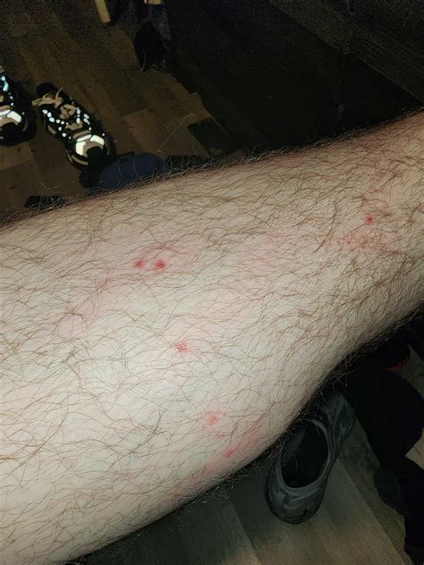 Red spots on leg. Very itchy when messed with. Thoughts? : r/Dermatology