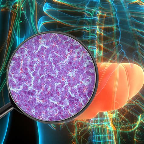 Understanding and Differentiating! NAFLD and NASH