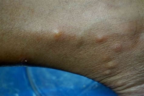 Flea Bites On Black People