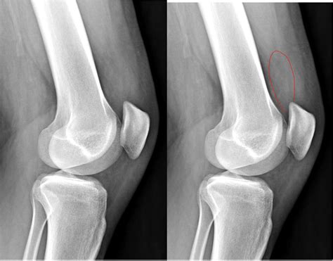 Knee Joint Effusions | Radiology Article | Radshare.net