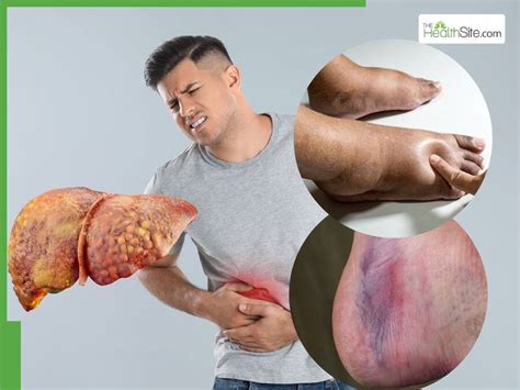 Fatty Liver Signs On Feet: 7 Indicators You Are Suffering From Last ...