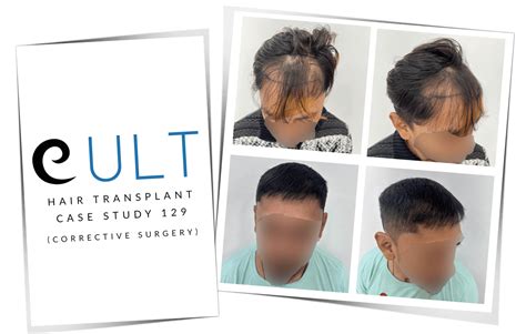 Hair Transplant Case Study 129 | Cult Aesthetics