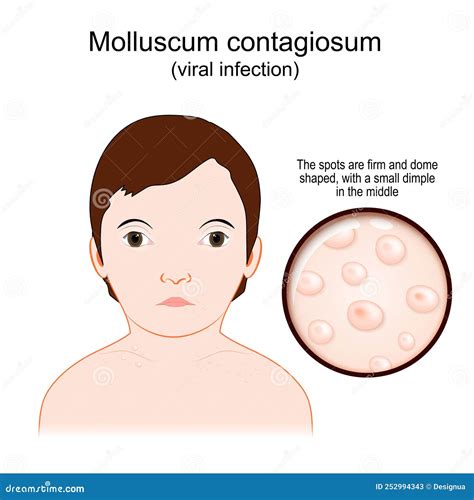 Molluscum Contagiosum. Water Warts Stock Vector - Illustration of ...