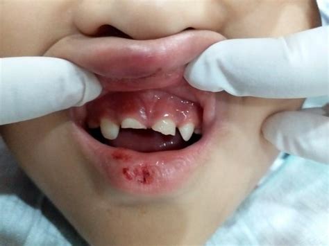 兒童牙齒意外受傷脫落或折斷怎麼辦？友好小白兔口腔的專家告訴你 - 每日頭條
