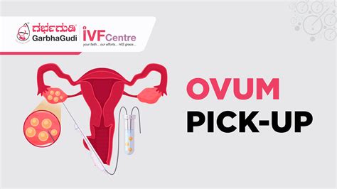 Ovum Pick-Up: Step-by-Step Guide to Egg Retrieval in IVF