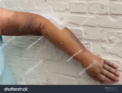 Bruise On Whole Arm Elbow Break Stock Photo 1496671751 | Shutterstock
