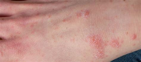 SCABIES TREATMENT THROUGH HOMEOPATHY