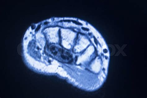 Image result for High-Resolution Hand MRI