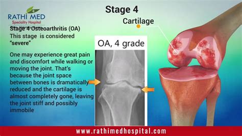 Osteoarthritis - An Introduction | Joint Pain Causes | Stages Of ...