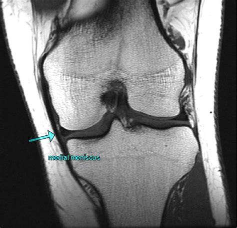 Figure 3 from MRI Evaluation of Internal derangement of the Knee Joint ...