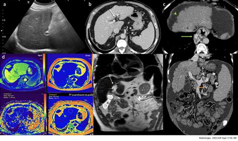 El informe radiológico en paciente con hepatopatía crónica | Radiología