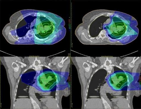 Is Proton Therapy Safer than Traditional Radiation? - NCI
