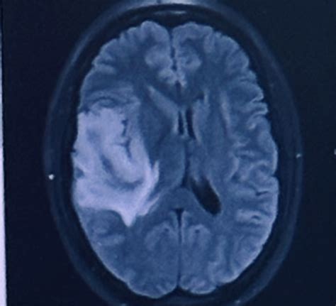 World Brain Tumour Day: Kimberley's story