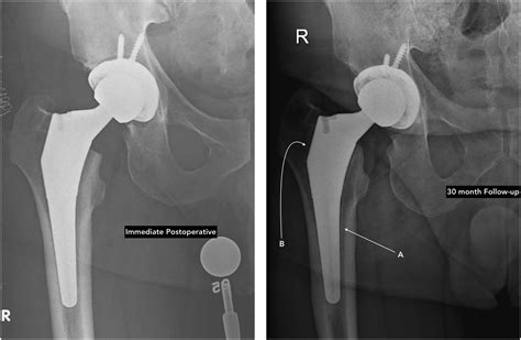 Diagnosis and Detection of Subtle Aseptic Loosening in Total Hip Arthroplasty - The Journal of ...