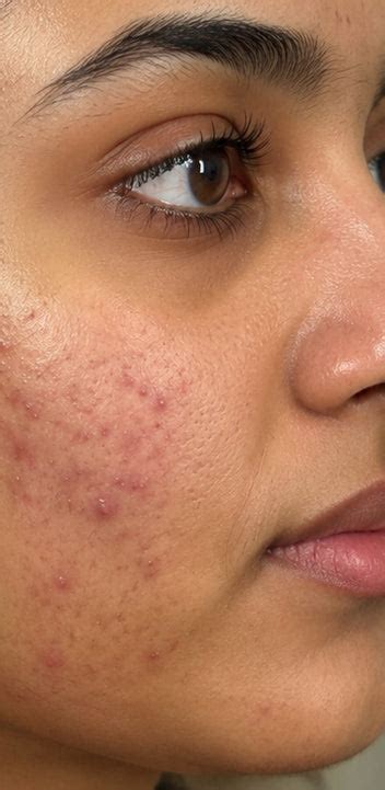 Alite Skincare – Clinically Tested Anti-Acne Products