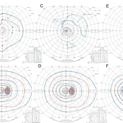 Image result for Abnormal Visual Field Testing